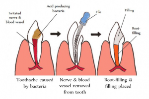 Root Treatment